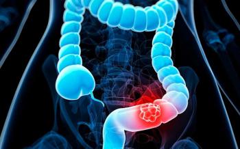 Kolon kanseri ve resveratrol 